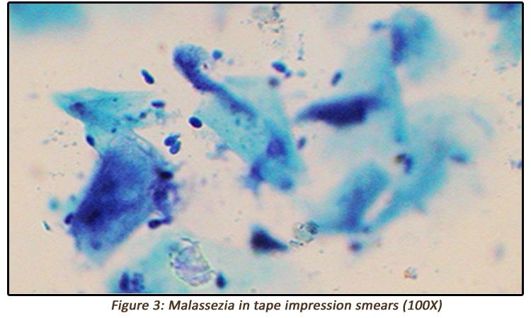 Microscopic view of Malassezia yeast on human skin cells